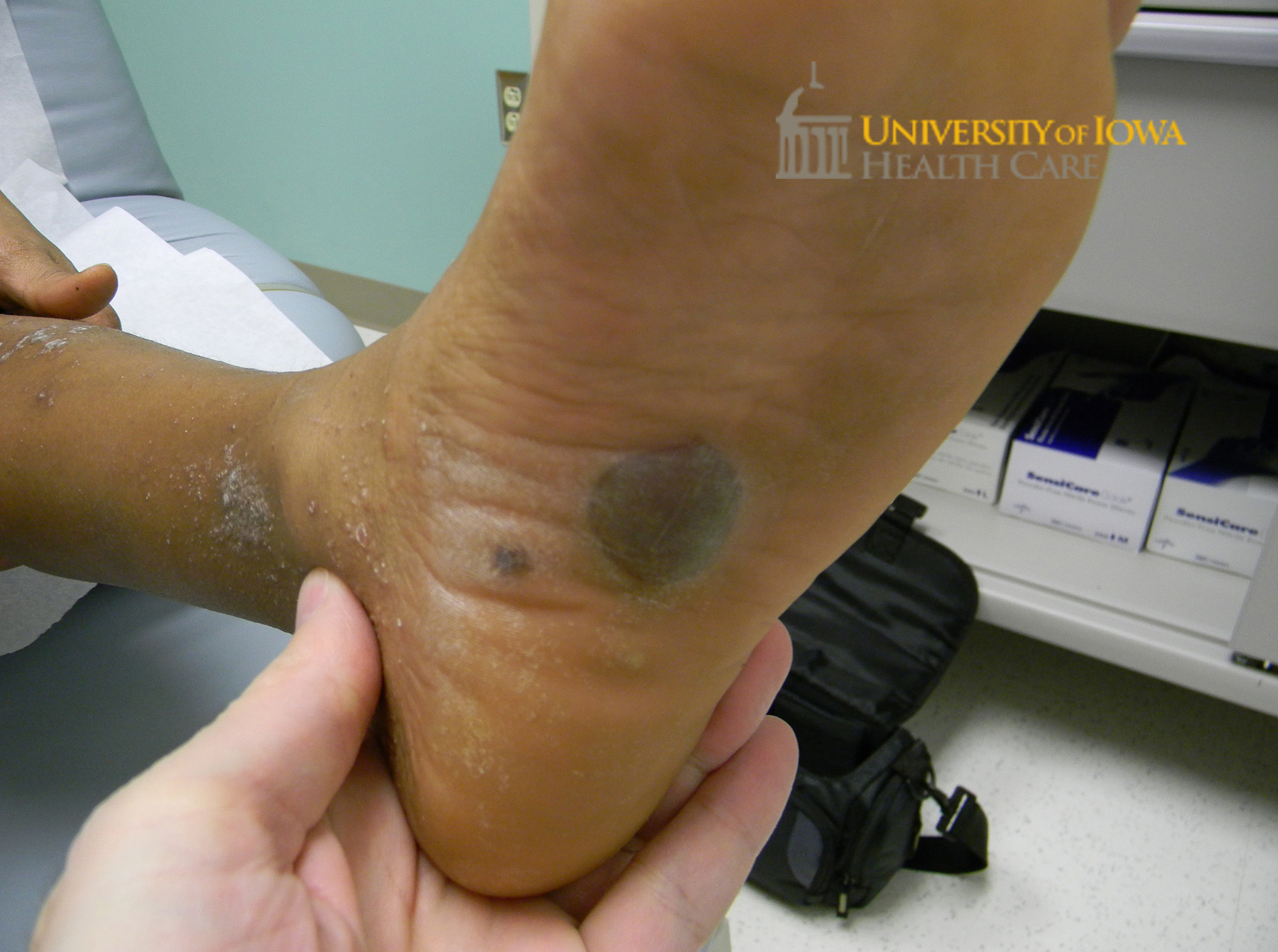 Pink to violaceous polygonal papules with overlying white scale coalesing into plaques on the lower extremity with hyperpigmented bulla on the dorsal foot. (click images for higher resolution).